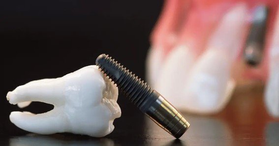 can you get dental insurance for implants