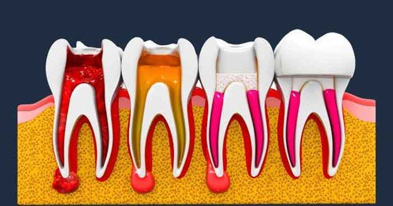 how much is a root canal with insurance