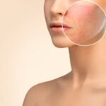 acne scar treatment covered by insurance