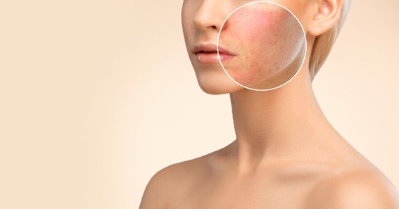 acne scar treatment covered by insurance