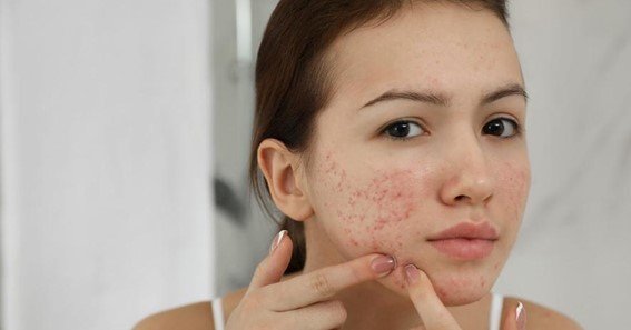 does medicaid cover acne scar removal