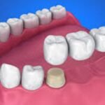 how much does a dental bridge cost with insurance