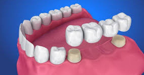 how much does a dental bridge cost with insurance