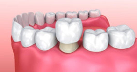 how much is a dental crown with insurance