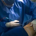 how much is liposuction with insurance