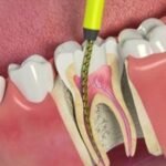 how much is root canal without insurance