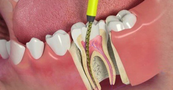 how much is root canal without insurance