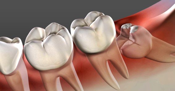 how much to take out wisdom teeth without insurance